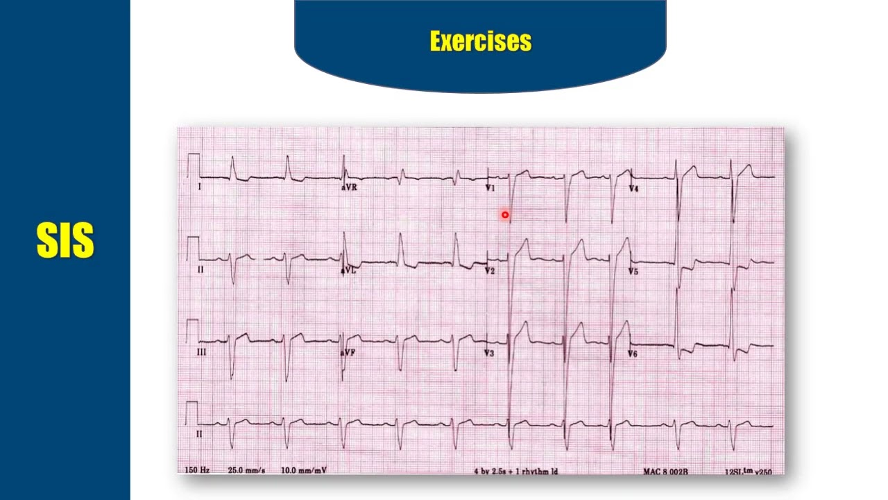 شرح تخطيط القلب (ECG) - الحلقة السادسة (QRS complex)