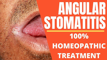 angular stomatitis || angular stomatitis homeopathic medicine || angular cheilitis !
