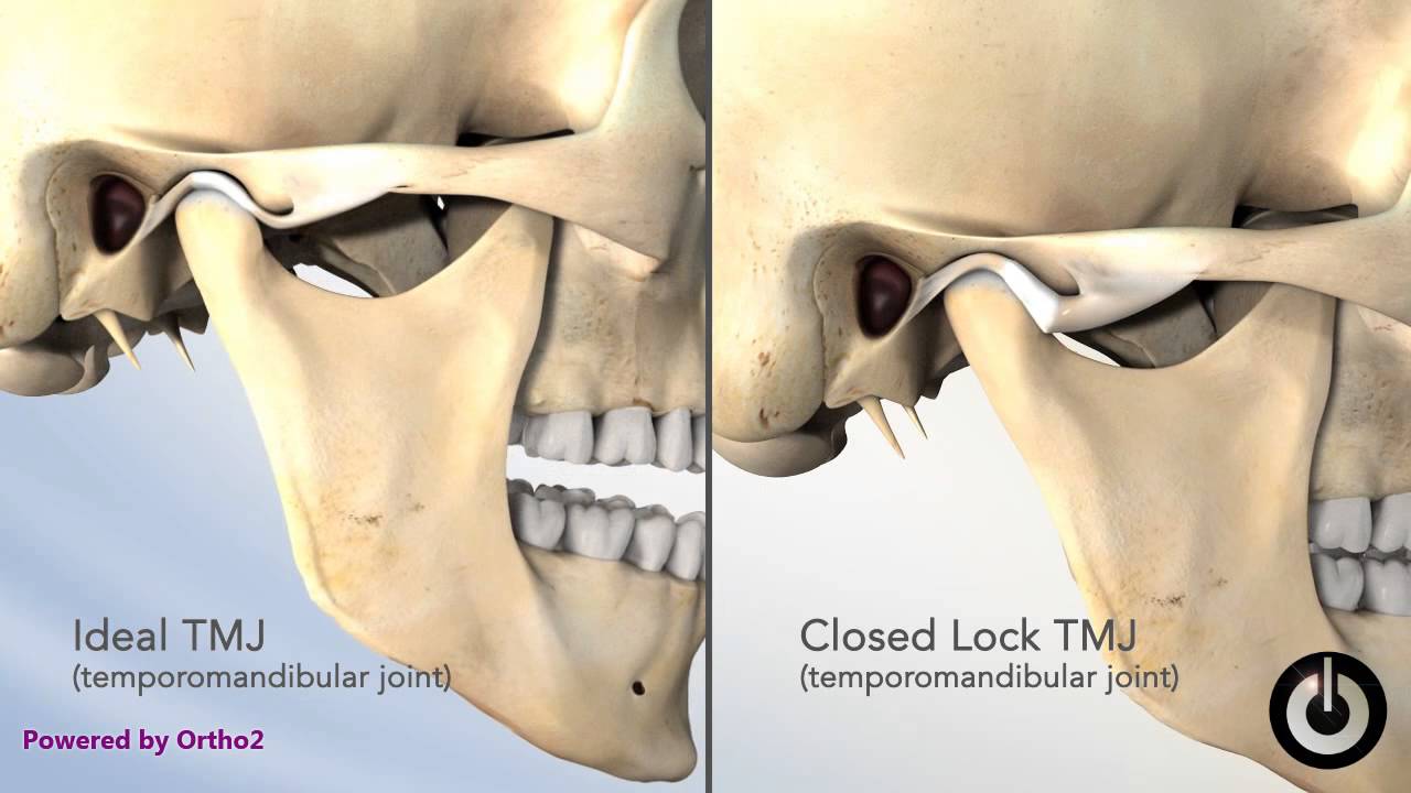 TMJ Closed Lock YouTube