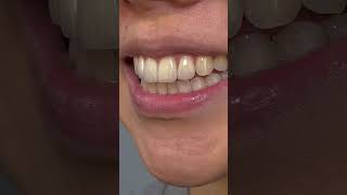 4 Veneers for this dentist patient.  #readdescription #veneers #dental