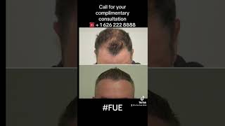 Before and After FUE Hair Transplant.  Best FUE Hair Restoration in Los Angeles California LA area.