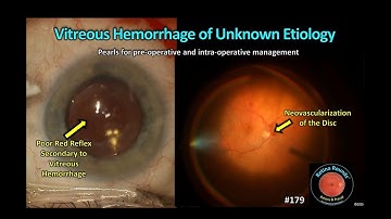 RetinaRounds™ 179: Glasvochtbloeding van onbekende oorzaak