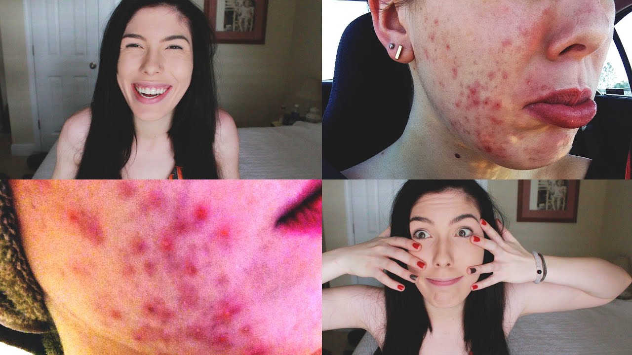 How To Get Rid of Acne // SKIN CARE ROUTINE - YouTube