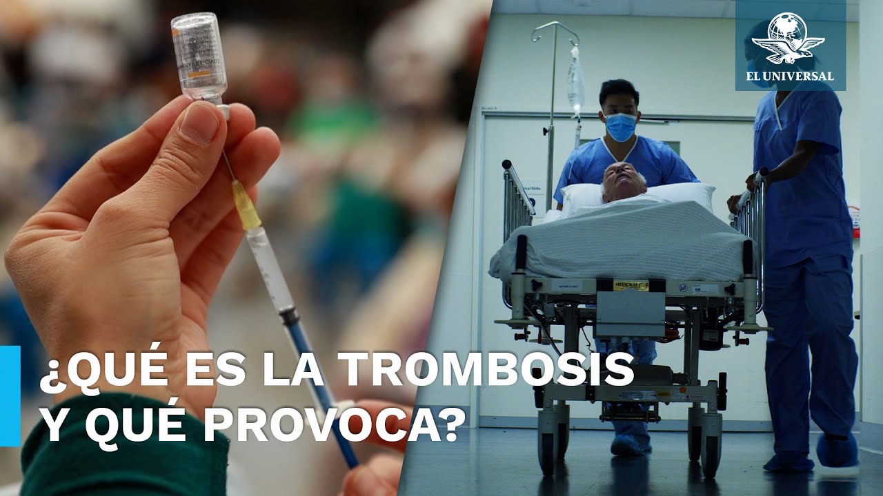 Esto debes saber sobre la Trombosis, enfermedad con la que ligan la vacuna antiCovid de AstraZeneca