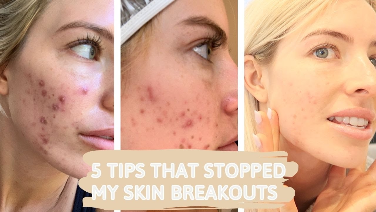 HOW I STOPPED MY SKIN BREAK OUTS || 5 Easy Tips - YouTube
