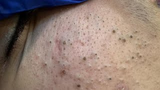 Satisfying Deep Blackhead Removal | Korean Skincare Routine for Glowing Skin!