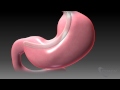 Sleeve gastrectomy