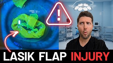 Misdiagnosed at first, This Can Happen 7 Years After LASIK! (Devastating Injury) | Patient Interview