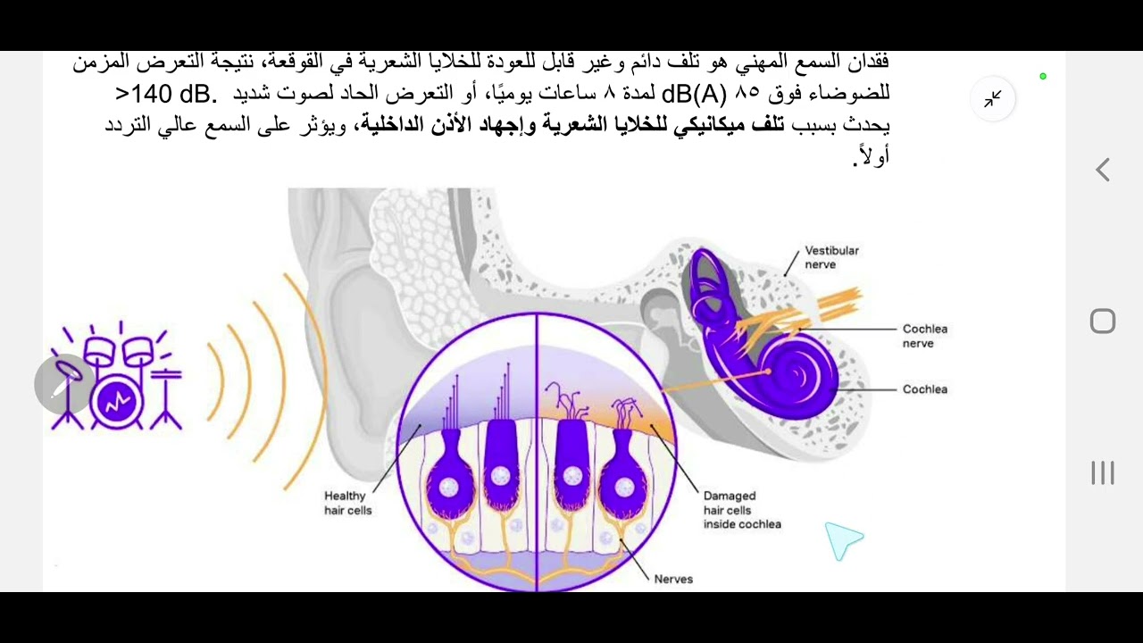 الأمراض المهنية الناتجة عن العوامل الفيزيائية (فقدان السمع المهني)