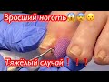 Вросший ноготь😱😨😯 • Тяжёлый случай🦶🏻