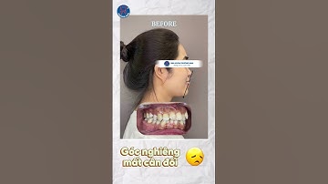 Sự thay đổi bất ngờ sau khi niềng răng Invisalign tại Nha khoa Phương Nam