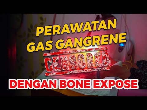 Video: Cara Merawat Gangren: 9 Langkah (dengan Gambar)