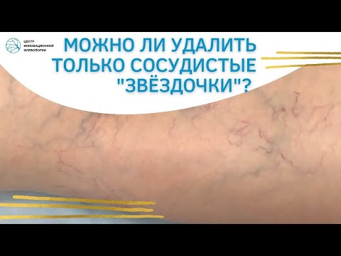 Можно ли удалить только сосудистые "звёздочки"? Флеболог Москва