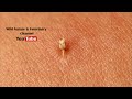 Do Honeybees Really Die When They Sting. Honey Bee Stinger - Super Close Up! Not Wasp Sting. Insects