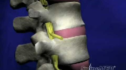 SpineMED® Decompression System Patient Education Video