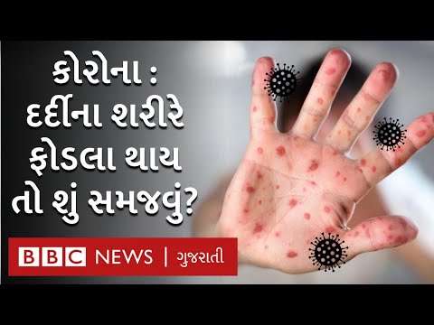 Coronavirus: દર્દીના શરીરમાં ફોડલા થાય તો તેનો મતલબ શું છે?