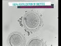 100% Fertilization in ICSI | The first step to successful IVF result | Fertilization check by 2PN