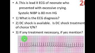 7. ECG: SVT تسرع القلب فوق البطيني