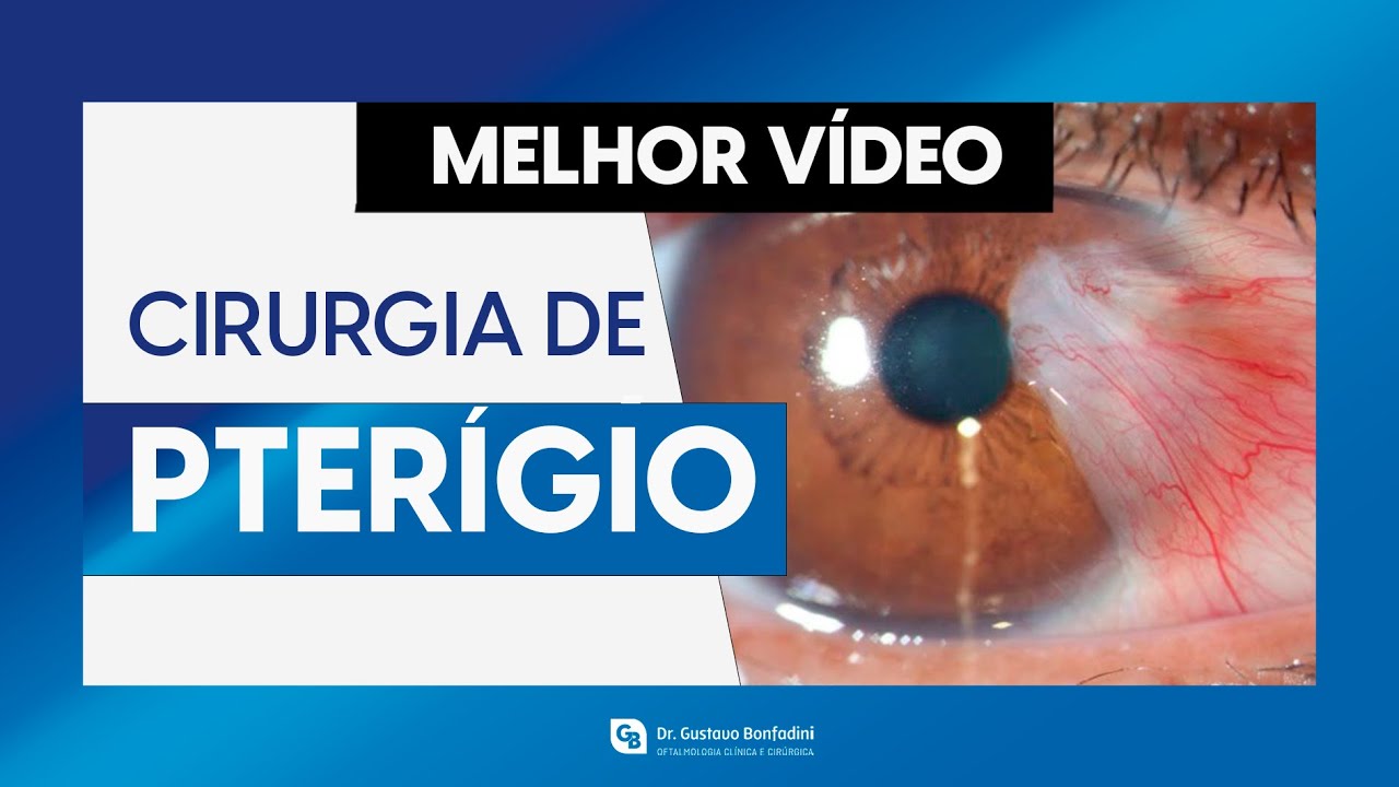 Cirurgia De Pterigio 20 Dias Depois - RETOEDU
