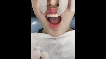 Nhược điểm của Dán Răng Sứ | Nhược điểm Dán Sứ | Nhược điểm Dán Veneer #rangsu #dansu #veneer