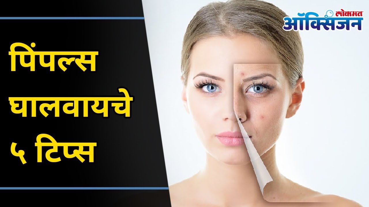 How To Get Rid Of Acne During Menstruation