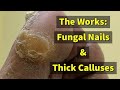 The Works: Fungal Nails & Thick Calluses 4K