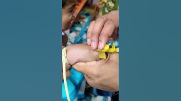 how to intravenous cannulation for 8 years child #ivcannulation #baby #viral #ivinsertiontechnique