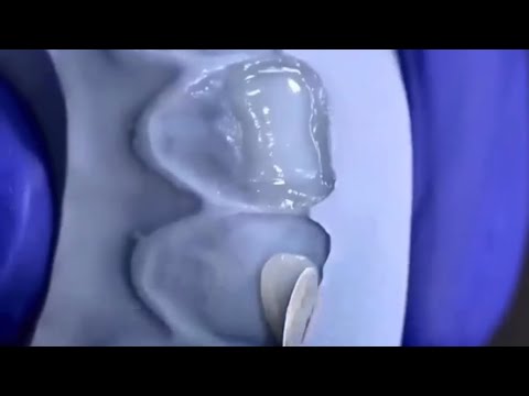 How to create Palatal Shells with composite on a matrix. - YouTube