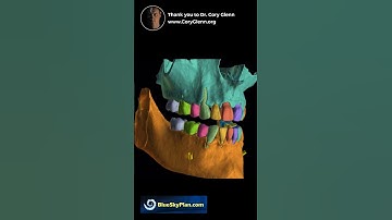 Automatic Segmentation #blueskyplan #treatmentplan #orthodontics #aligners #dentistry #clearaligners
