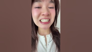 Mới đó mà e sắp niềng răng xong luôn dồiii🥺 #chouiu #review #niềngrăngtrongsuốt