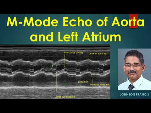 Video: Melebihi Echo Klasik Dalam Stenosis Aorta: Kiri Mekanik Atrium, Penanda Baru Keparahan