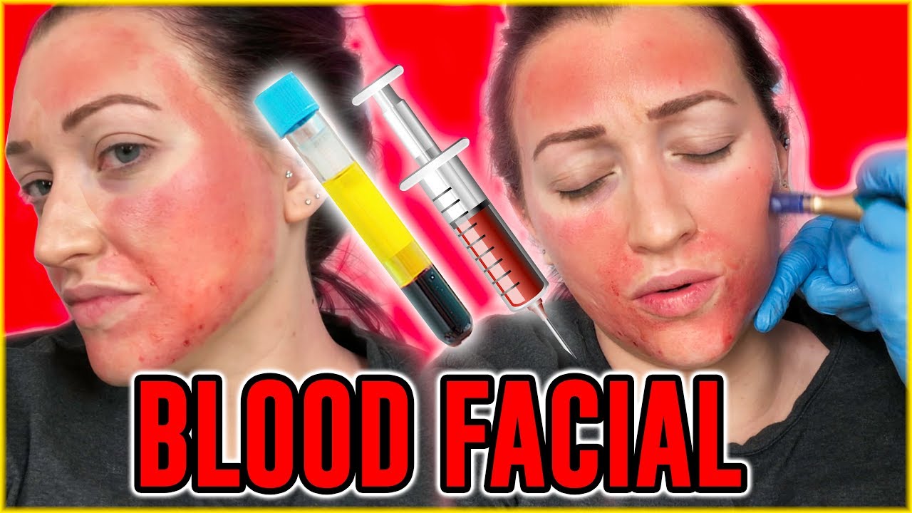 I Got The Vampire Facial for Acne Scars- Worth the $$$??
