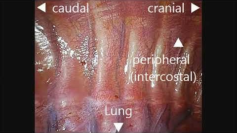 Observation of ultrasound-guided thoracic paravertebral block using thoracoscopy