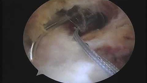 Arthroscopic Rotator cuff repair: partial bursal side tear Dr.Bancha Chernchujit
