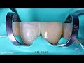 Two Composite Veneers - Upper Centrals