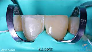 Two Composite Veneers - Upper Centrals