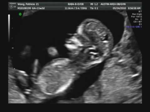 10 week sonogram 10 week sonogram
