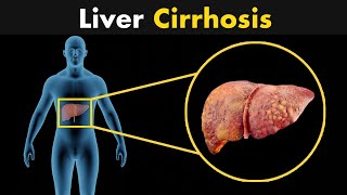 What is liver cirrhosis? | Symptoms, Diagnosis and treatment (3D Animation)