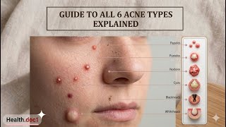6 types of acne explained - how to identify and how to get rid of acne. 