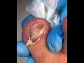 Professional toenails cleaning by professional doctor 