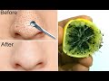 ब्लैक हेड्स ऐसे हटाएगा ये नुस्खा जैसे कभी थे नहीं | blackheads removal | blackheads hatane ke upay