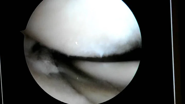 Dr. Robert Eppley. Arthroscopic Knee Surgery Video - 3