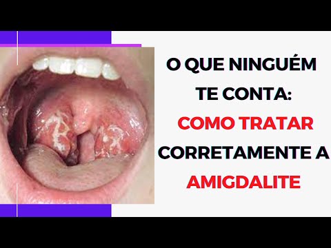 Vídeo: A amigdalite passa?