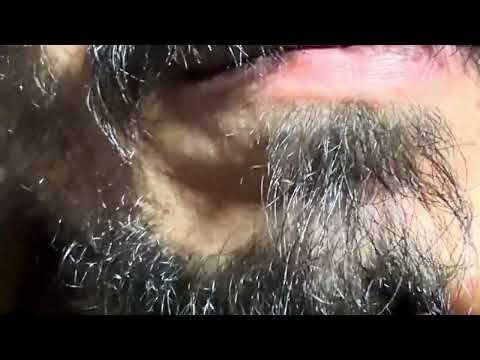 Ingrown hair 11 barbar bashing | ingrown hair satisfying