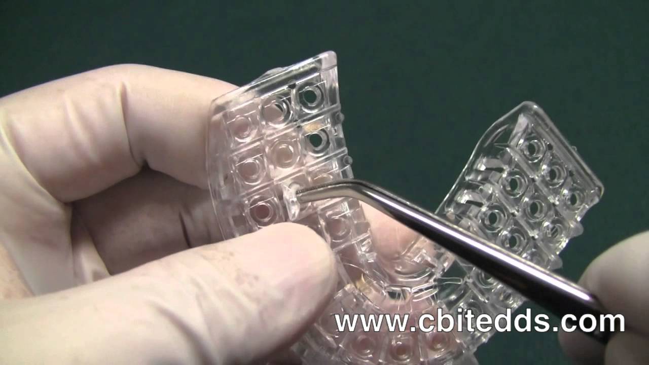 Open tray technique for dental implants with the Implant Tray™ Quick