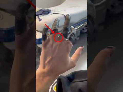أصابع مفقودة في الجبال