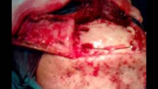 En como la coágulos cabeza de sangre encontrar