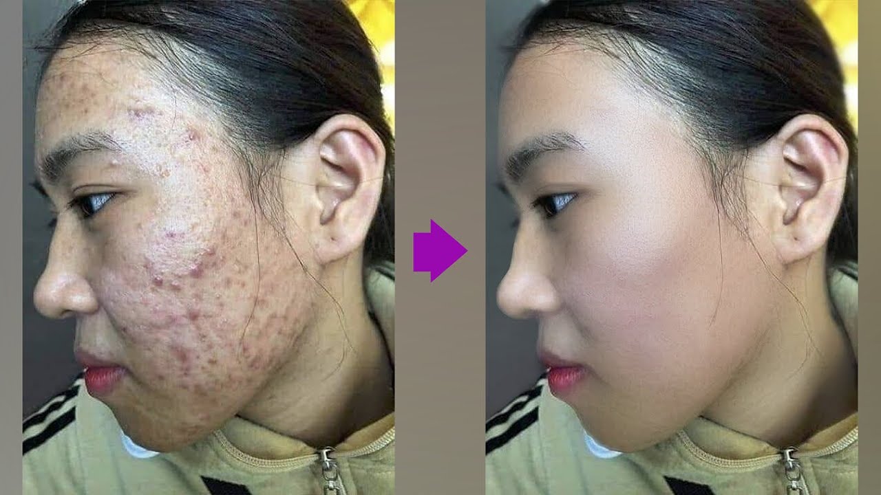 Xóa mụn trong photoshop | Nguyễn Ngọc Trung