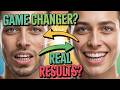 Dentists Won’t Tell You This! BioDentex Review – Secret for Healthy Teeth &amp; Gums?