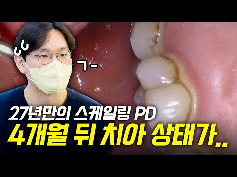 스케일링 4개월 후 치아 상태 점검 📝ㅣ 아직도…검은 치석이 나온다?😱(feat.잇몸치료 예고)